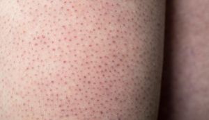 Keratosis Pilaris