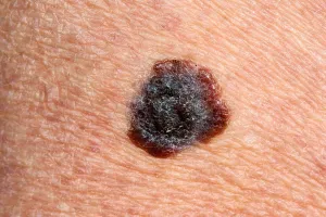 Melanoma