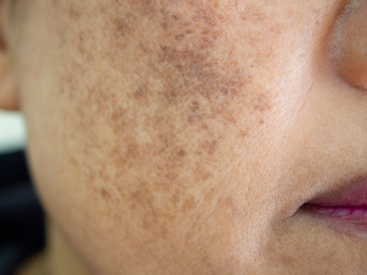 Melasma Treatment Melasma Treatment
