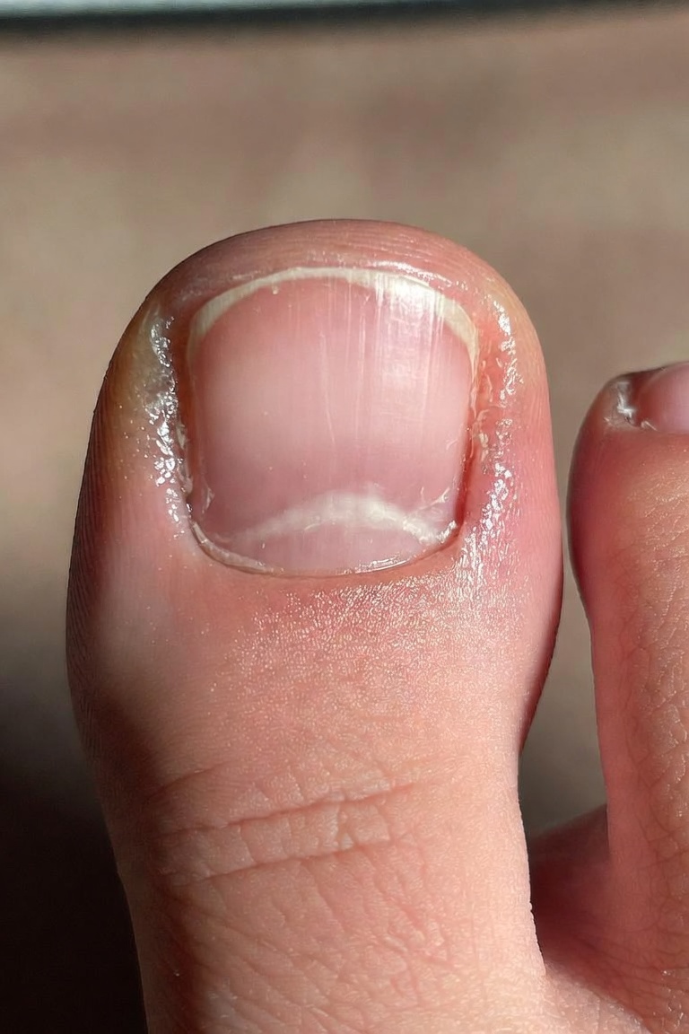 Onychomycosis, commonly known as nail fungus, is a persistent fungal infection of the fingernails or toenails. 