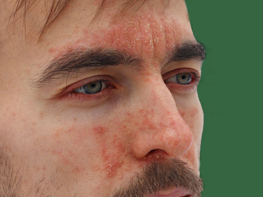 Perioral dermatitis presents with small red bumps and mild peeling that can occur around the mouth, nose, and eyes (less commonly). This condition can be somewhat itchy or cause a burning sensation. Perioral dermatitis presents with small red bumps and mild peeling that can occur around the mouth, nose, and eyes (less commonly). This condition can be somewhat itchy or cause a burning sensation.
