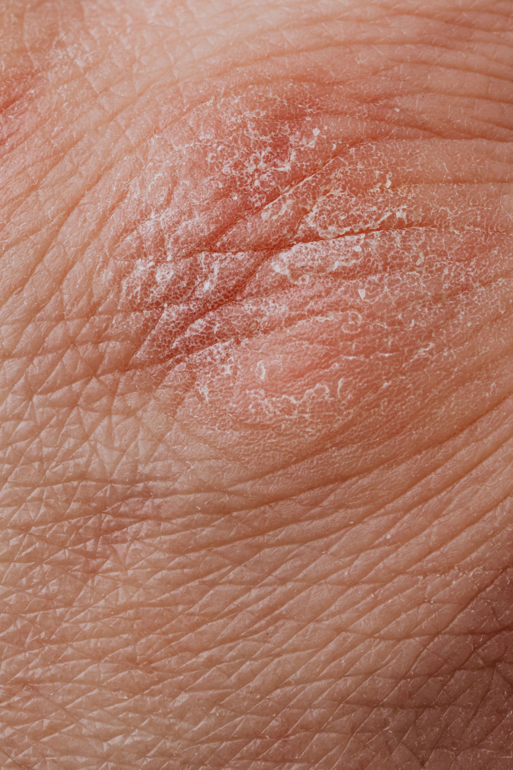 Psoriasis is a persistent skin disorder in which there are red, thickened areas with silvery scale.