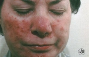Example of Acne Rosacea