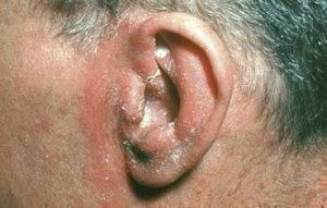 Example of Seborrheic Dermatitis