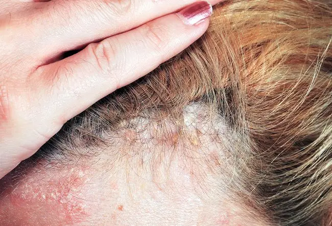 seborrheic-dermatitis Seborrheic Dermatitis