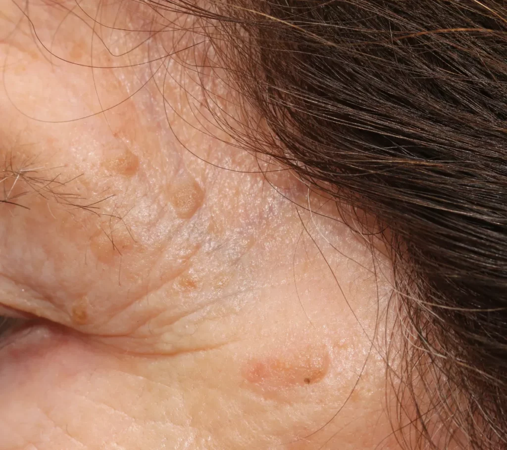 Seborrheic keratoses are very common, benign skin growths that typically appear after age 40. Often called “age spots” or “wisdom warts,” they are harmless and not contagious. Seborrheic keratoses are very common, benign skin growths that typically appear after age 40. Often called “age spots” or “wisdom warts,” they are harmless and not contagious.