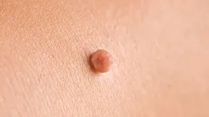 Skin Tags