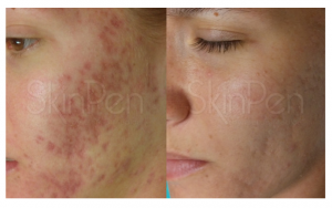 SkinPen Microneedling for Acne