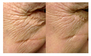 SkinPen Microneedling for Wrinkles