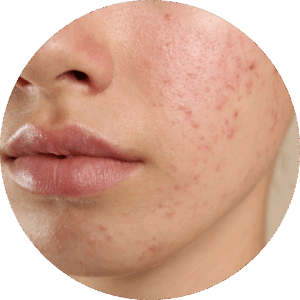 Acne Dermatologist
