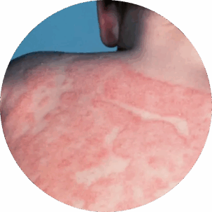 Atopic Dermatitis Dermatologist