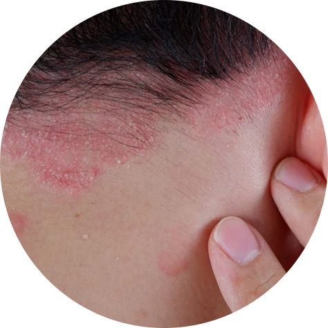 Eczema Skin Dermatologist