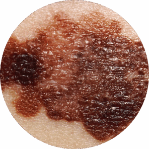 Melanoma Skin Screening