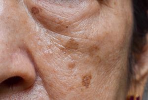 Sun damage and uneven pigmentation, often called photoaging or solar lentigines, result from cumulative UV exposure over years. Sun damage and uneven pigmentation, often called photoaging or solar lentigines, result from cumulative UV exposure over years.