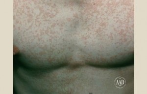 Chest with Tinea Versicolor