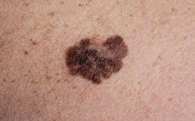 Ugly Duckling Skin Cancer