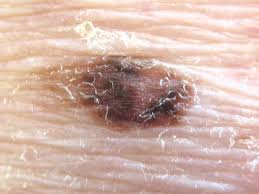Ugly Duckling Skin Cancer