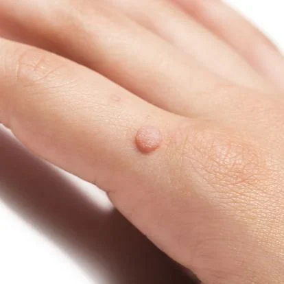 Warts are caused by the human papillomavirus (HPV) which is contagious. Warts are caused by the human papillomavirus (HPV) which is contagious.