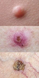 What does basal cell carcinoma look like?
