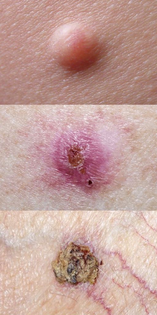 What does basal cell carcinoma look like?